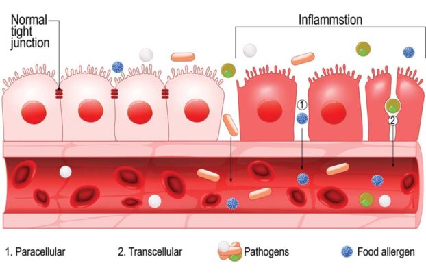 Leaky Gut Syndrome Symptoms (and How To Treat it ASAP)
