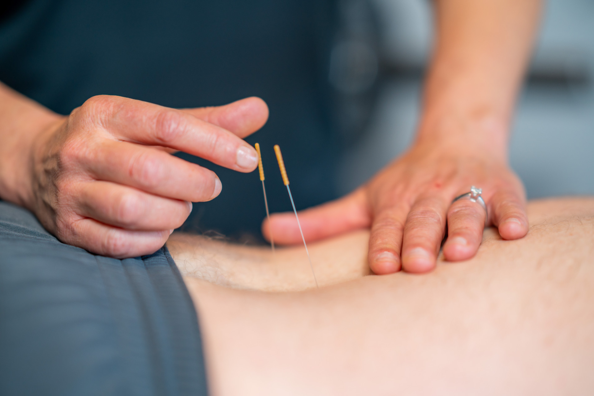 Dry Needling for Pain Relief: How It Enhances Chiropractic Care, Physical Therapy, and Regenerative Treatments
