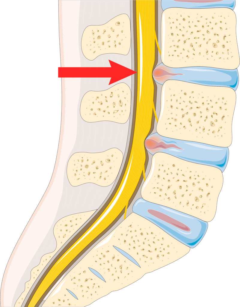 Medical illustration of lumbar spine cross-section showing herniated disc pressing on spinal nerve with inflammation. Let me know if you'd like a version tailored for anatomy education, spine health content, or clinical documentation.