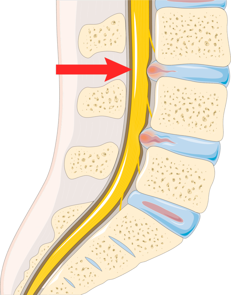 Medical illustration of lumbar spine cross-section showing herniated disc pressing on spinal nerve with inflammation. Let me know if you'd like a version tailored for anatomy education, spine health content, or clinical documentation.