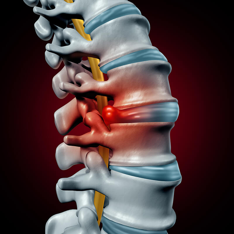 3D medical illustration of herniated disc bulging between vertebrae and pressing on spinal nerve with inflammation. Let me know if you'd like a version tailored for medical education, patient guides, or spine health content.