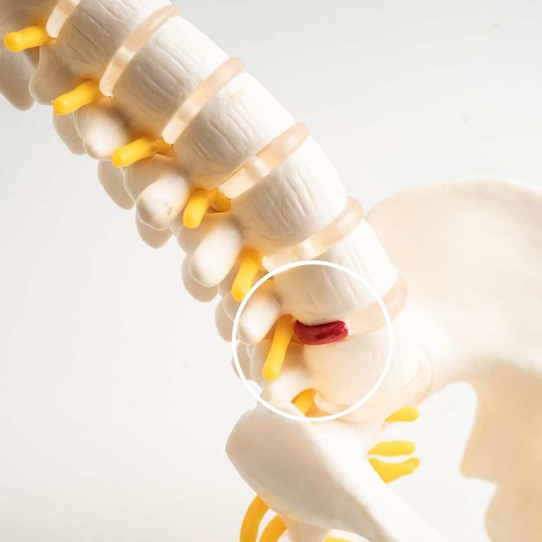 Anatomical model of the lower lumbar spine showing a herniated disc compressing a yellow nerve root near the pelvis.