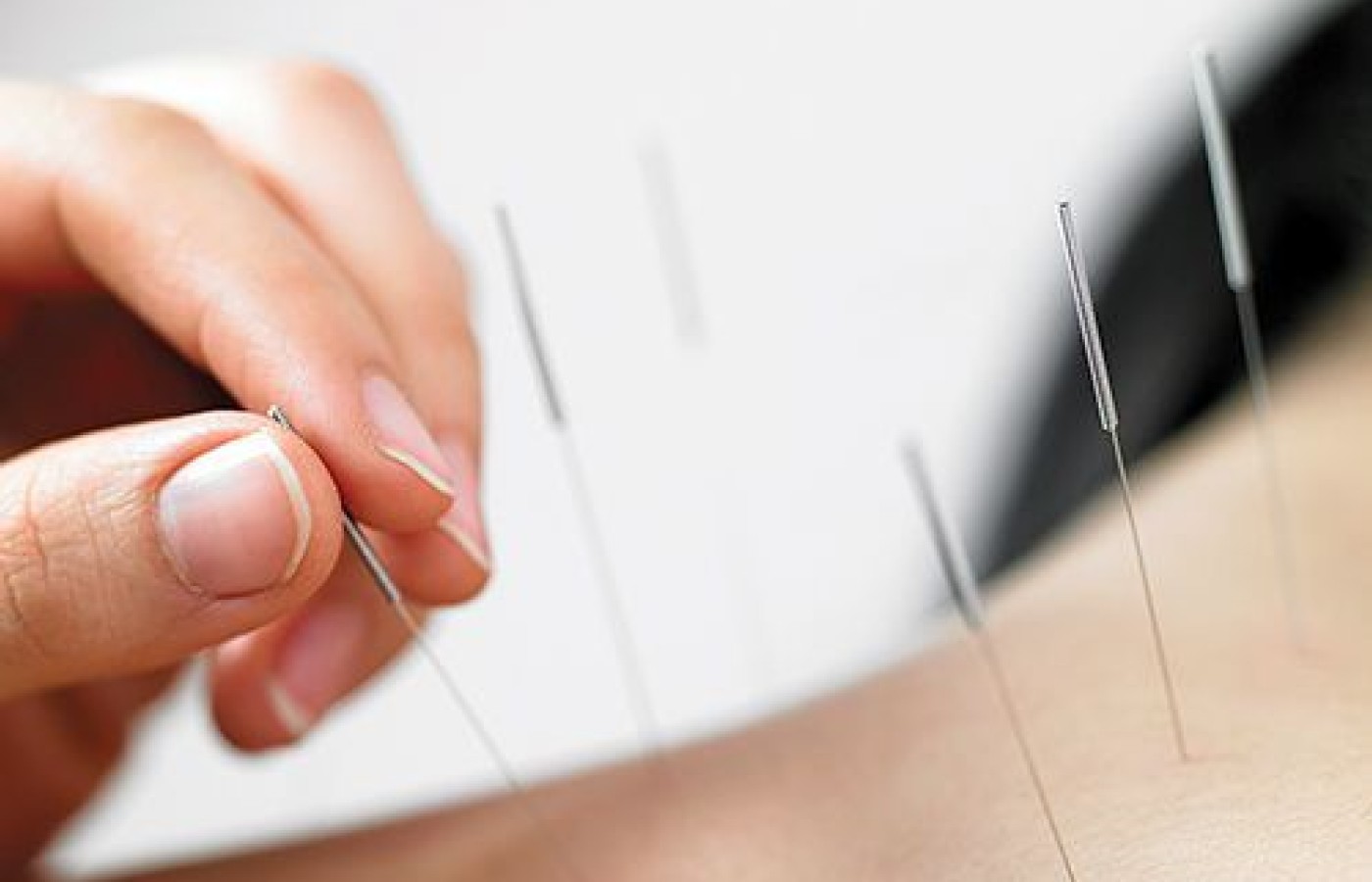 Dry Needling Therapy: A Modern Approach to Relieving Muscle Pain and Restoring Movement