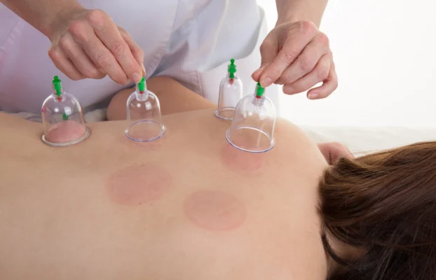 Ancient Therapy Meets Modern Pain Relief: Understanding Cupping Techniques