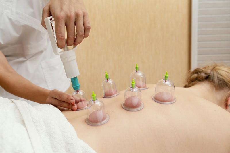 What to Expect During a Cupping Therapy Session