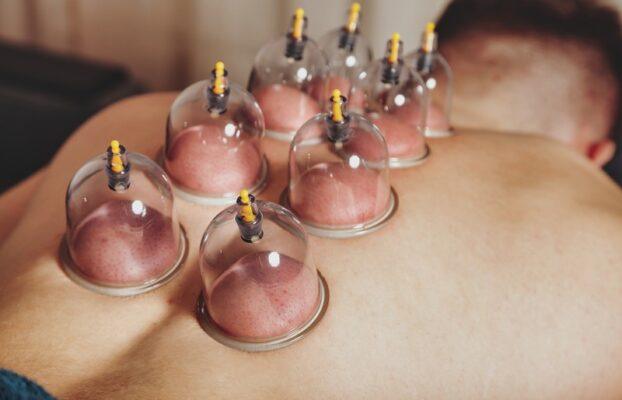 An Ancient Practice with Modern Day Results: Cupping Therapy Benefits