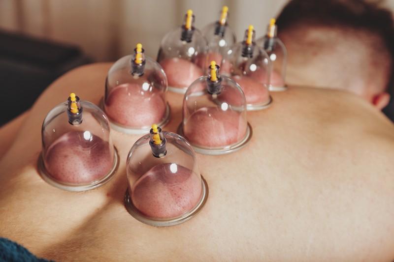 An Ancient Practice with Modern Day Results: Cupping Therapy Benefits