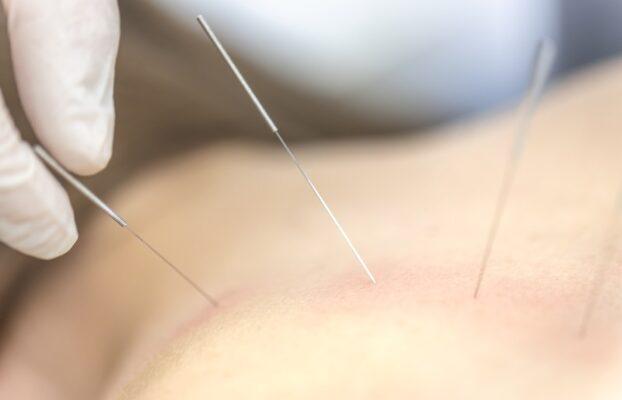 How Is Dry Needling Different from Acupuncture?