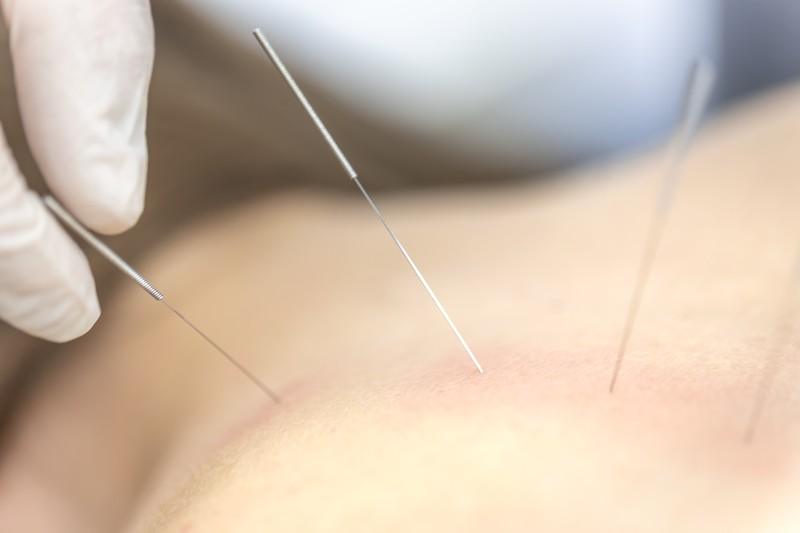 How Is Dry Needling Different from Acupuncture?