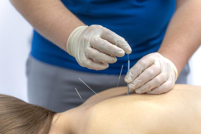 Dry Needling for Pain Relief: How It Enhances Chiropractic Care, Physical Therapy, and Regenerative Treatments