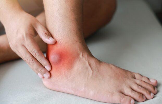 Grade 1 Ankle Sprain: How Soon Can I Play Sports?