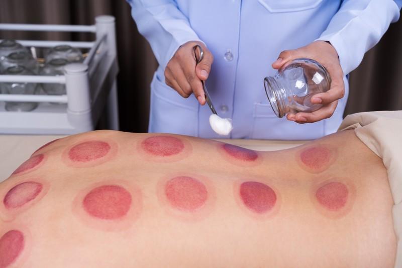 Relieve Pain Naturally: Expert Cupping Therapy at Elite Spine & Health Center