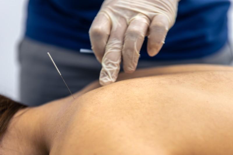 Cupping, Dry Needling & Graston: Alternative Therapies That Work
