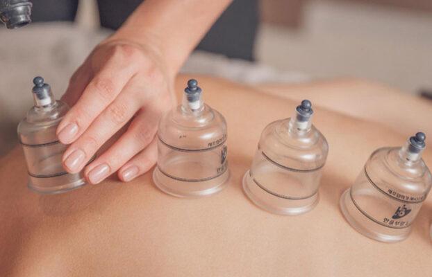 Cupping Vs. Acupuncture: A Comparison