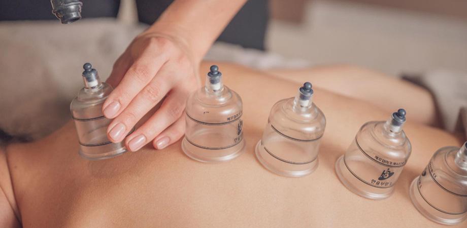 Cupping Vs. Acupuncture: A Comparison